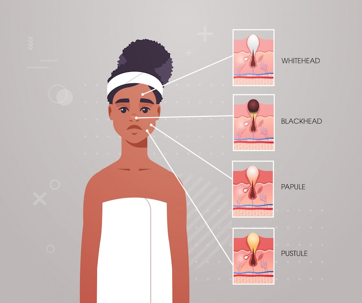 Vector diferentes tipos de piel facial acné pústula pápula espinilla espinilla espinillas en mujer cara poro comedones cosmetología problemas de cuidado de la piel concepto retrato plano