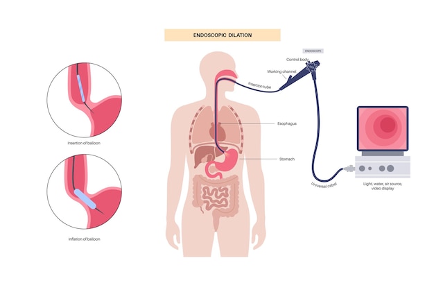 Dilatación neumática endoscópica Endoscopia superior procedimiento mínimamente invasivo Trastorno del esófago la terapia con balón para la acalasia interrumpe las fibras musculares en el esfínter esofágico inferior cerrado