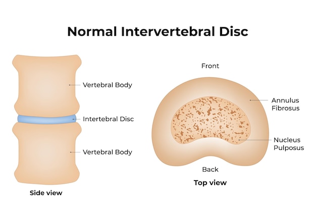 Vector disco intervertebral normal anulo fibroso núcleo pulposo corpo vertebral lateral y vista de arriba