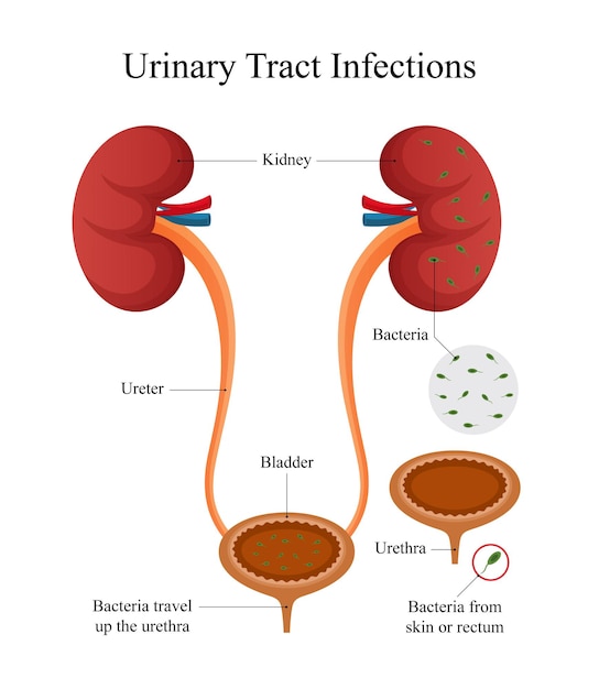 Diseño de diagramas de infecciones del tracto urinario para médicos