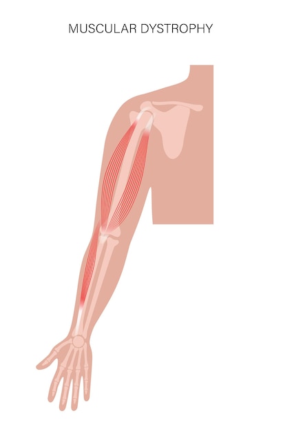 Distrofia muscular del brazo