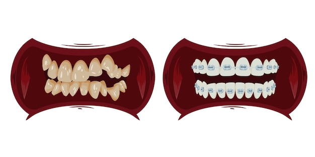 Dos imágenes de curvas de dientes a la izquierda y amarillas a la derecha dientes lisos y blancos dientes entre corchetes están limpios y son hermosos8963