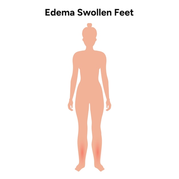 Edema y hinchazón de los pies