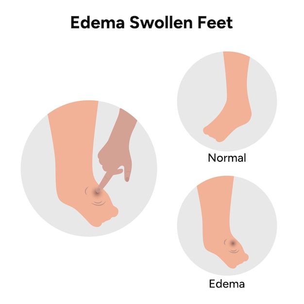 Edema y hinchazón de los pies