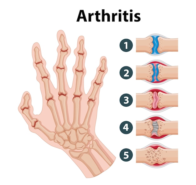 Educación en la ciencia de la anatomía humana infografía sobre las etapas de la artritis