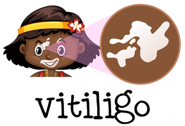 Vector educación médica humana del vitiligo