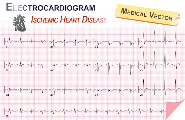 Vector electrocardiograma de la cardiopatía isquémica (infarto de miocardio)