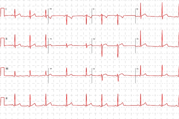 Electrocardiograma humano típico, gráfico rojo con marcas