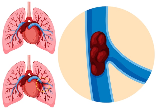 Vector embolia pulmonar de anatomía humana