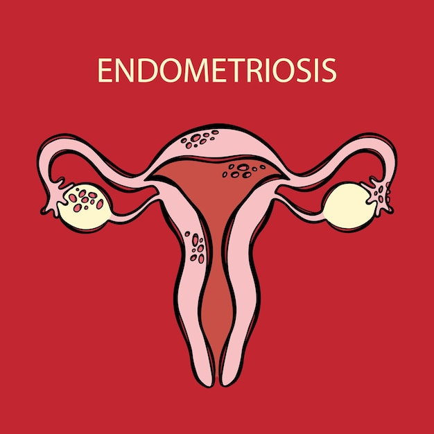 Endometriosis educación en medicina del sistema reproductor femenino