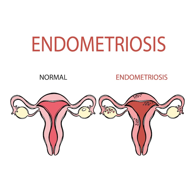 Endometriosis femenina normal aparato reproductivo educación