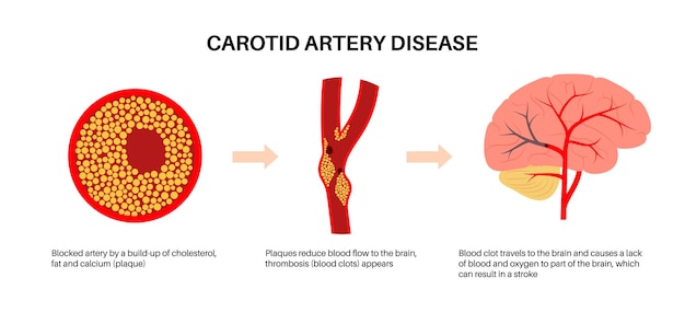 Enfermedad de la arteria carótida
