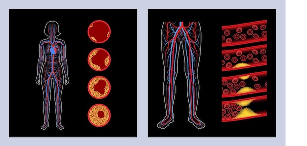 Enfermedad arterial periférica Isquemia en la pierna Colesterol en vaso sanguíneo humano Concepto PAD