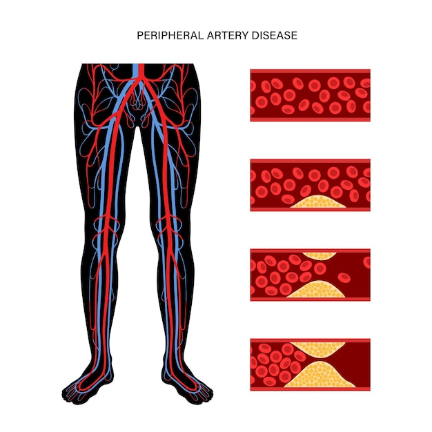 Vector enfermedad arterial periférica