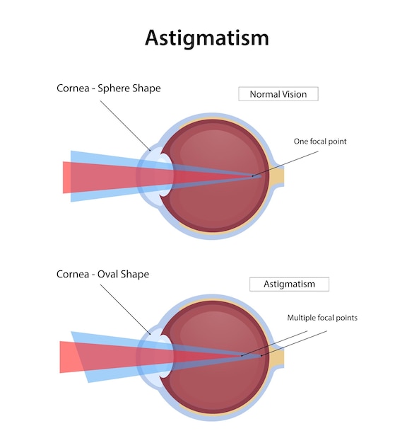 Enfermedad de astigmatismo, visión normal y diseño de ilustración de astigmatismo.