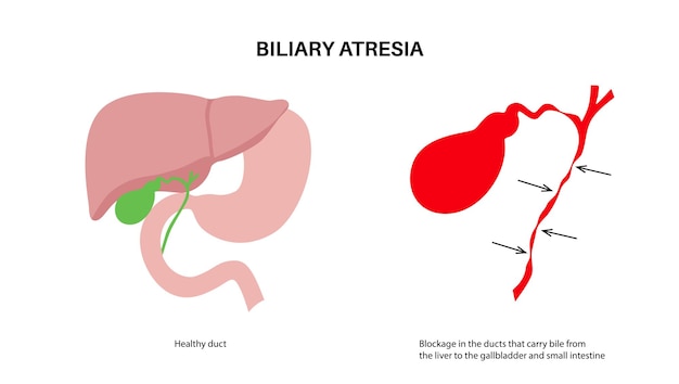 Enfermedad de atresia biliar