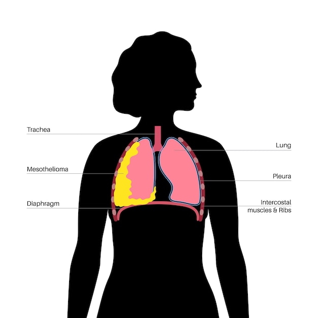 Enfermedad de cáncer de mesotelioma