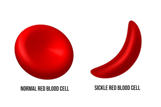 Enfermedad de células falciformes la diferencia de glóbulos rojos normales y células falciformes