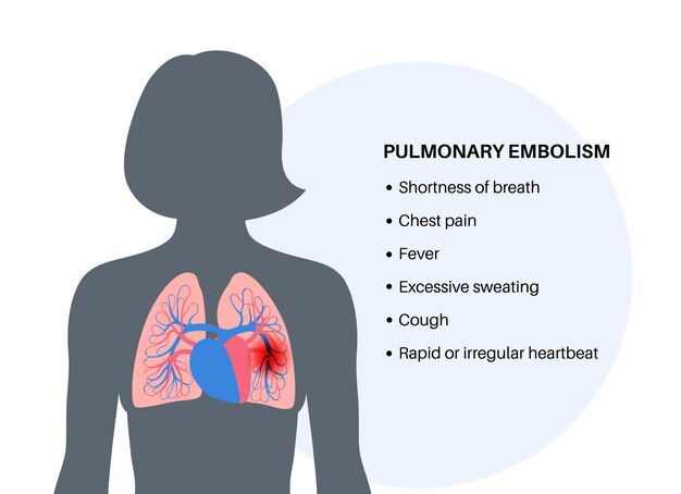 Vector enfermedad de embolia pulmonar