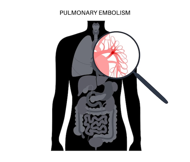 Enfermedad de embolia pulmonar