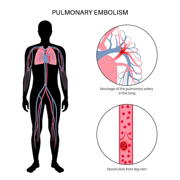 Vector enfermedad de embolia pulmonar