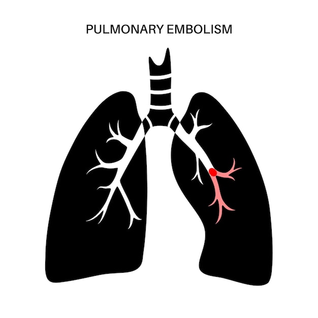 Vector enfermedad de embolia pulmonar