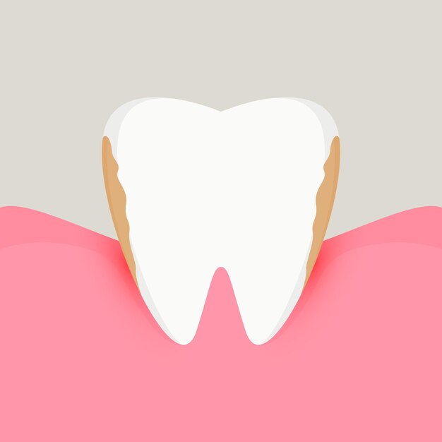 enfermedad de las encías enfermedad periodontal
