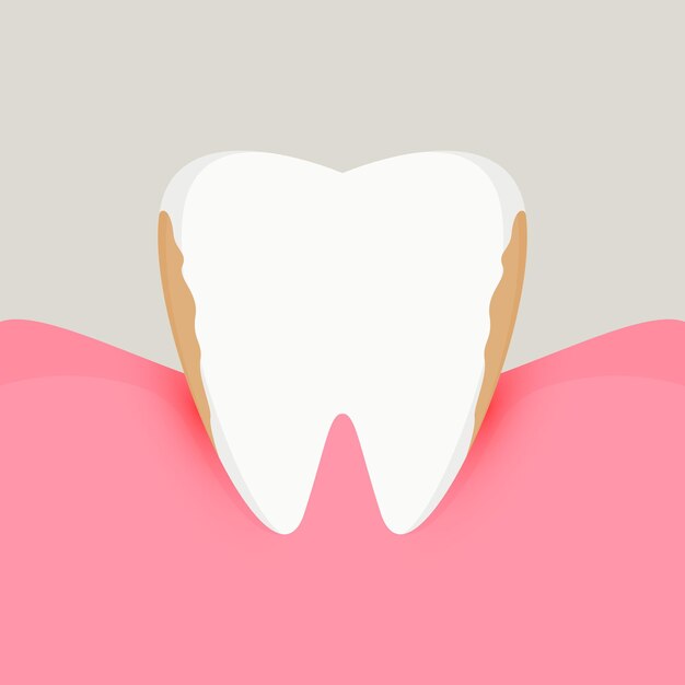 Enfermedad de las encías enfermedad periodontal