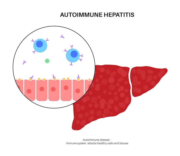 Vector enfermedad de hepatitis autoinmune