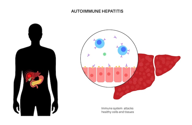 Vector enfermedad de hepatitis autoinmune