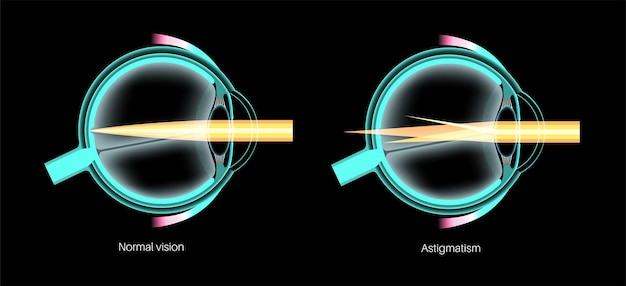 Enfermedad ocular del astigmatismo