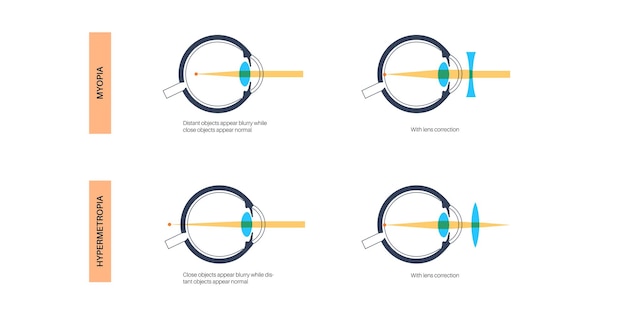 Vector enfermedad ocular del astigmatismo