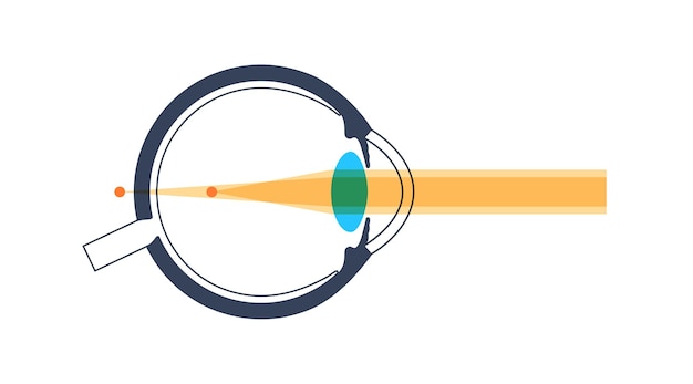 Vector enfermedad ocular del astigmatismo