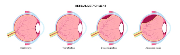 Enfermedad ocular por desprendimiento de la retina