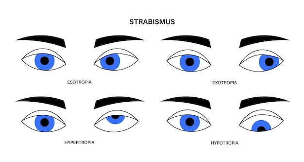 Enfermedad ocular del estrabismo