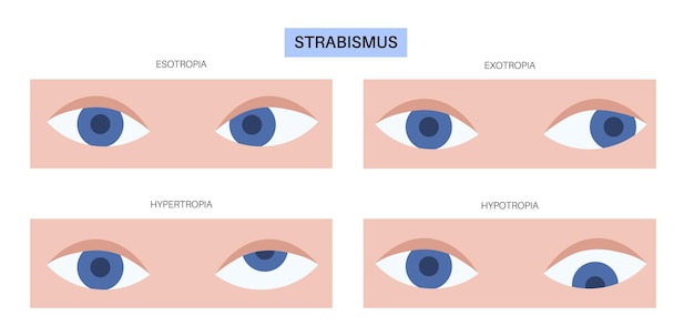Enfermedad ocular del estrabismo