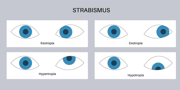 Vector enfermedad ocular del estrabismo