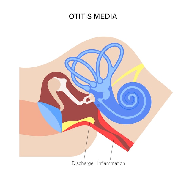 Vector enfermedad de la otitis media