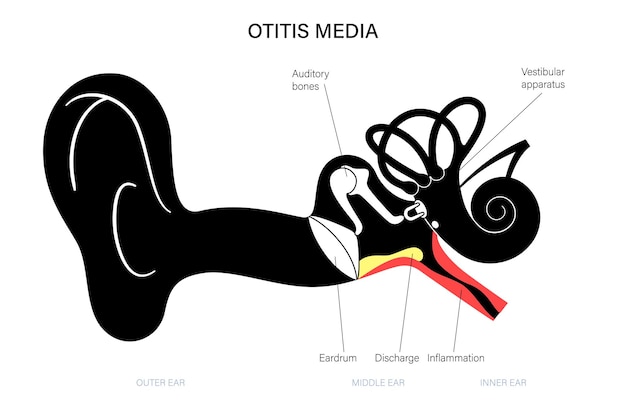 enfermedad de la otitis media