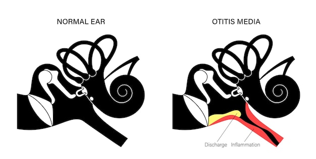 Enfermedad de la otitis media