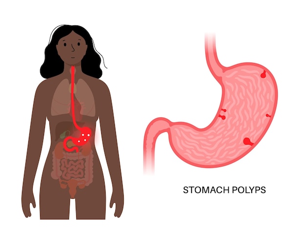 Vector enfermedad de los pólipos estomacales