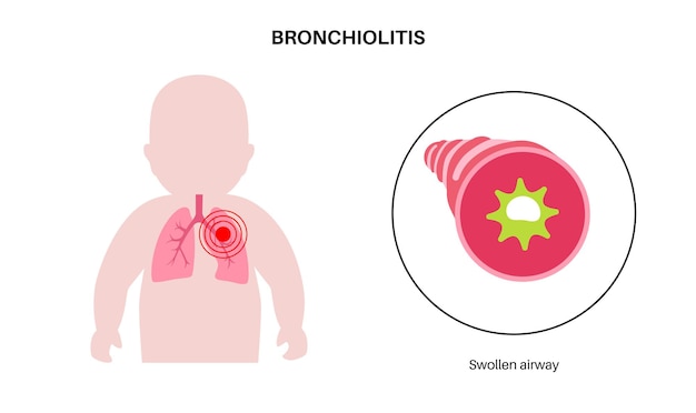 Enfermedad pulmonar de la bronquiolitis