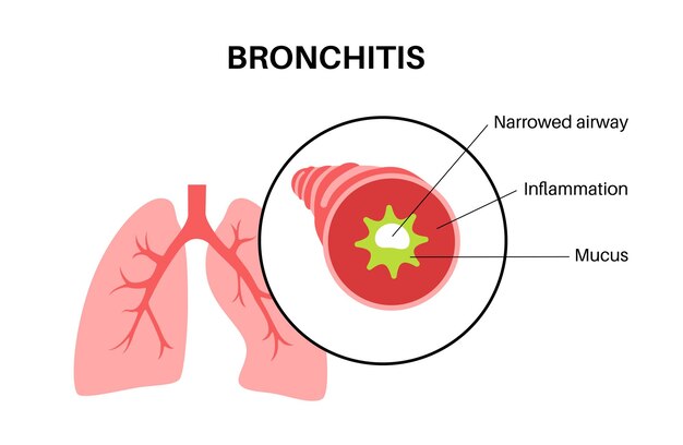 Enfermedad pulmonar de la bronquitis