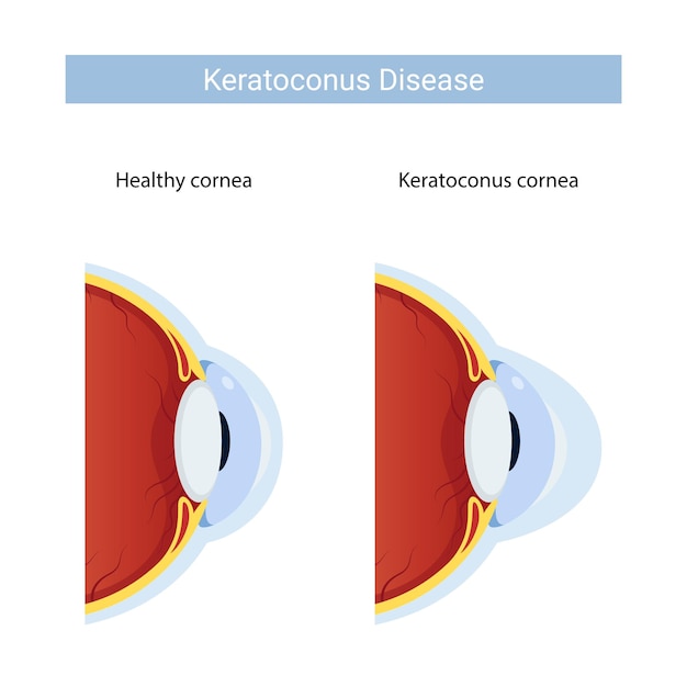 Vector enfermedad de queratocono, diseño de ilustración para médico, vector de córnea