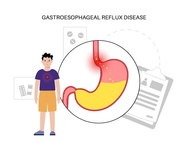 Vector enfermedad por reflujo gastroesofágico. niño en clínica. trastorno digestivo y erge en el cuerpo del niño. dolor, acidez estomacal en pecho, estómago y esófago. el esfínter abierto permite la ilustración de vector plano de reflujo ácido