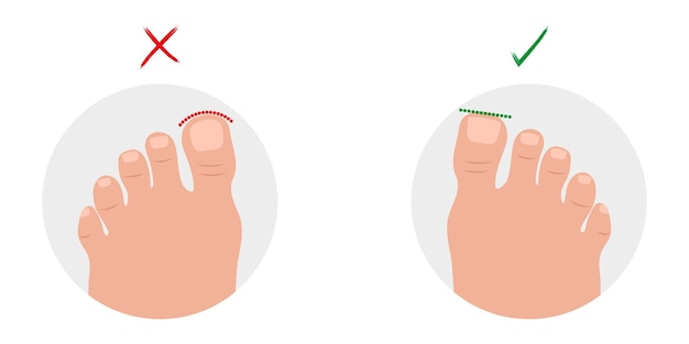 Enfermedad de las uñas de los pies encarnadas forma correcta e incorrecta de la uña de los pies