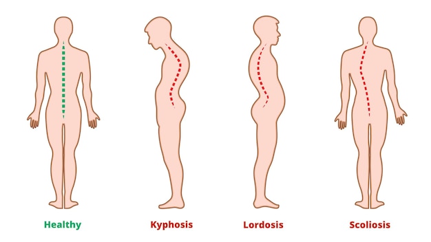 Enfermedades de la columna. Escoliosis, lordosis, cifosis. Defectos de postura corporal. Curvatura de espalda. Tipos de deformidad espinal. Infografía de enfermedades médicas. Síntoma diagnóstico. Ilustración vectorial.