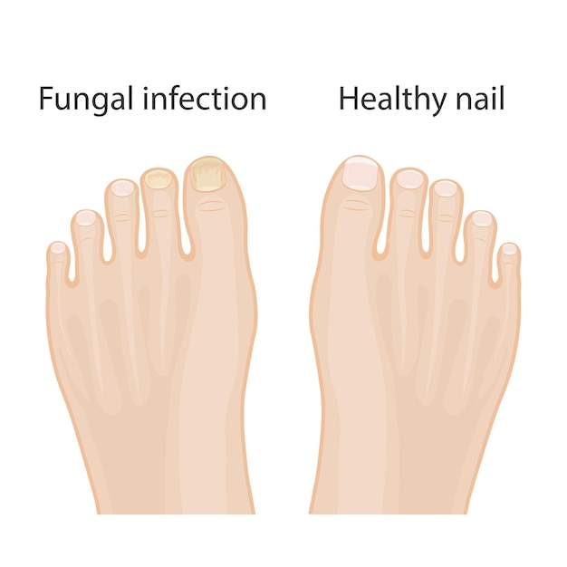 Vector enfermedades de las uñas onicomicosis causas de infección por hongos de las uñas diseño de infografías médicas