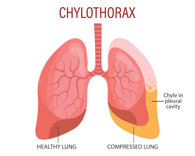 Vector enfermedades pulmonares del quilotorax cuidado de la salud vector de ilustración de pancartas infográficas médicas