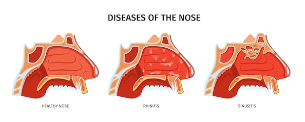 Vector enfermedades de la sección transversal anatómica de la nariz con sinusitis nasal sana y rinitis ilustración vectorial realista